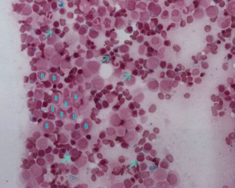 Myelodysplastic Syndrome