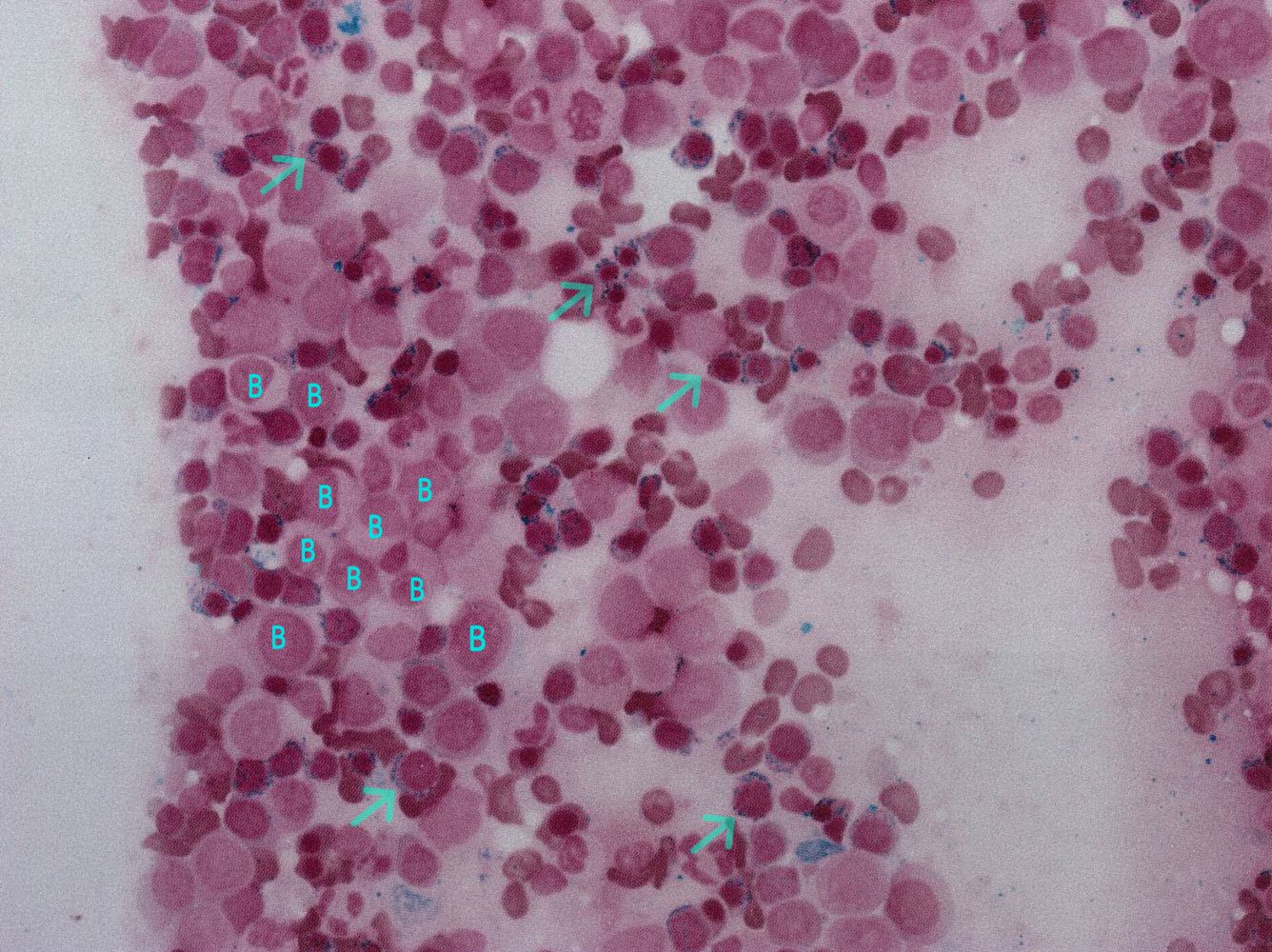 Myelodysplastic Syndrome