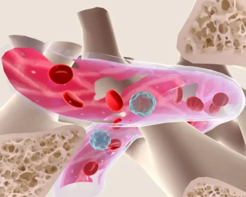 Myelodysplastic Syndrome